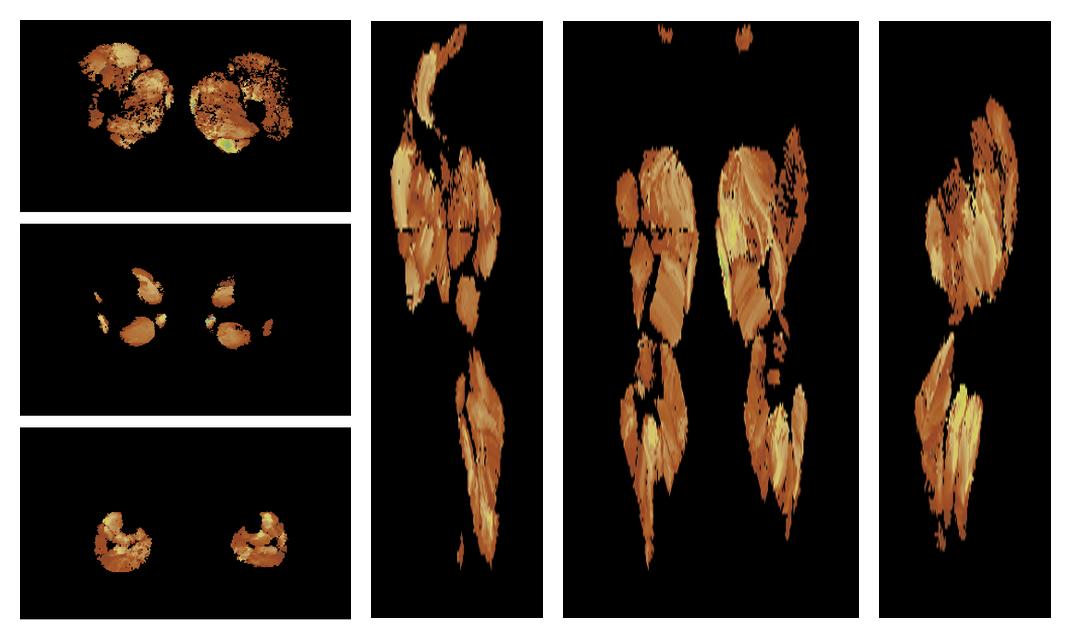 Muscle fiber tract length map based on whole leg DTI based fiber tractography.