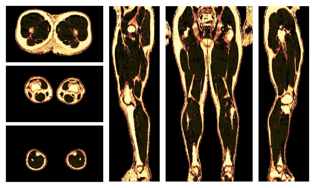 The fat fraction of the lower extremity obtained from the dixon reconstruction for muscle water fat quantification.