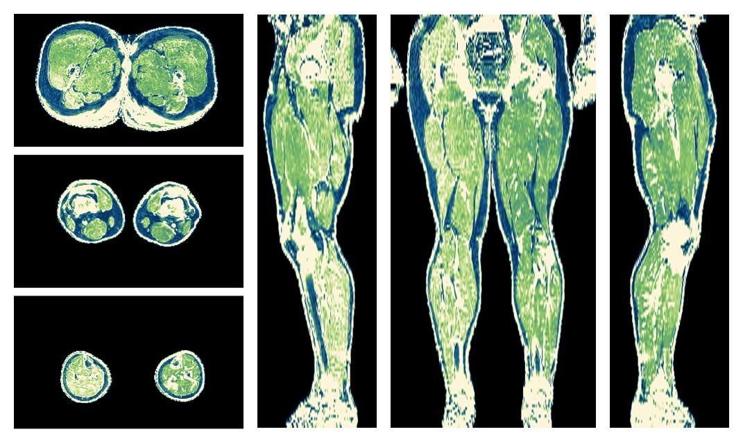 The R2 star relaxation time of the lower extremity obtained from the dixon reconstruction for muscle water fat quantification.