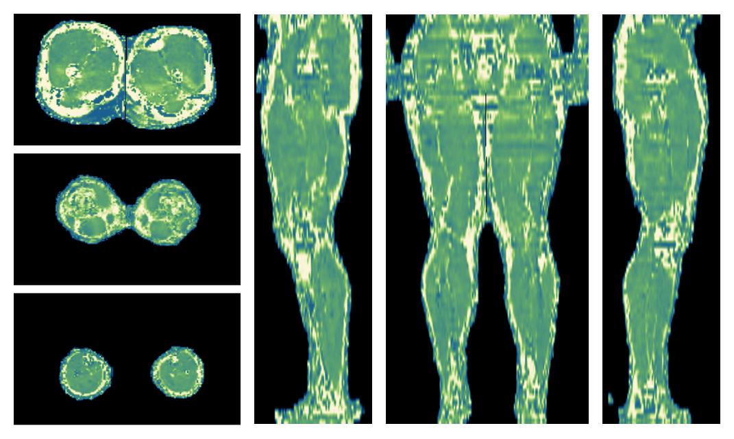 The water only T2 relaxation time of the lower extremity obtained from multi echo spin echo t2 mapping with EPG based reconstruction.