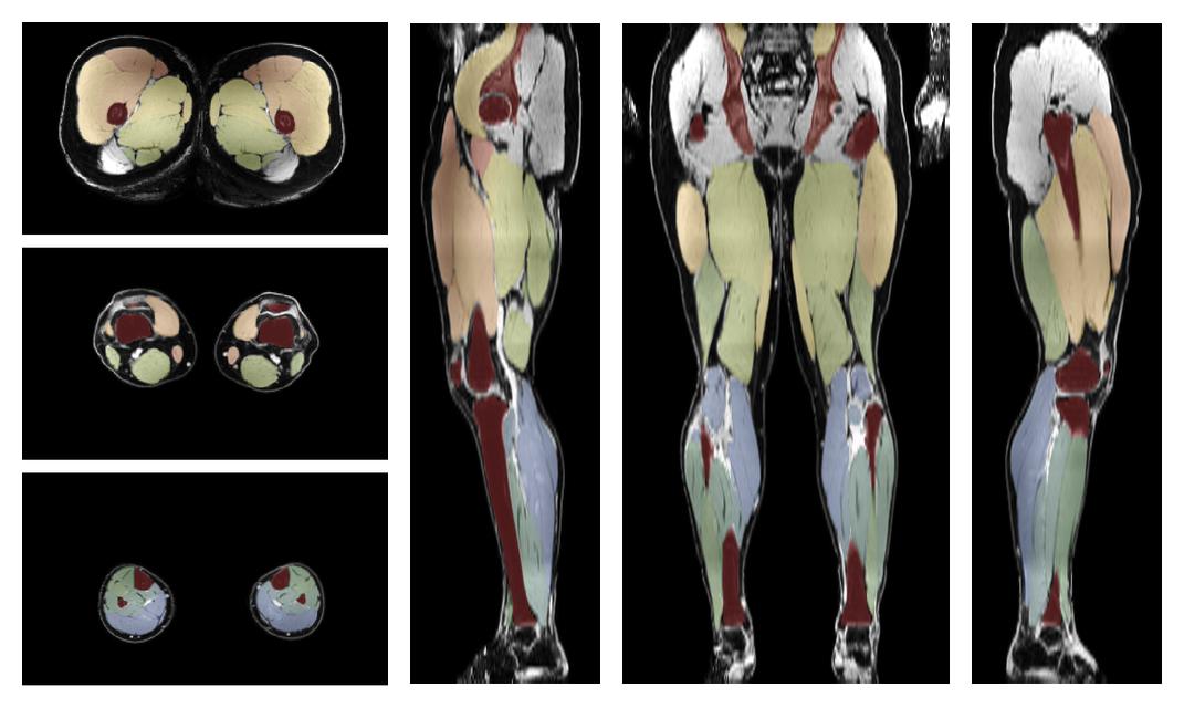 Overlay of automated muscle segmentation labels on dixon water image.