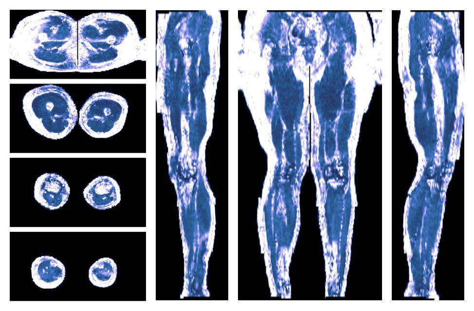 IVIM corrected whole leg muscle fractional anisotropy obtained from diffusion tensor imaging.