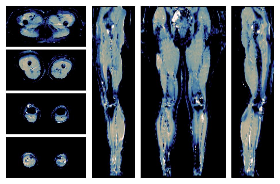 IVIM corrected whole leg muscle mean diffusivity obtained from diffusion tensor imaging.