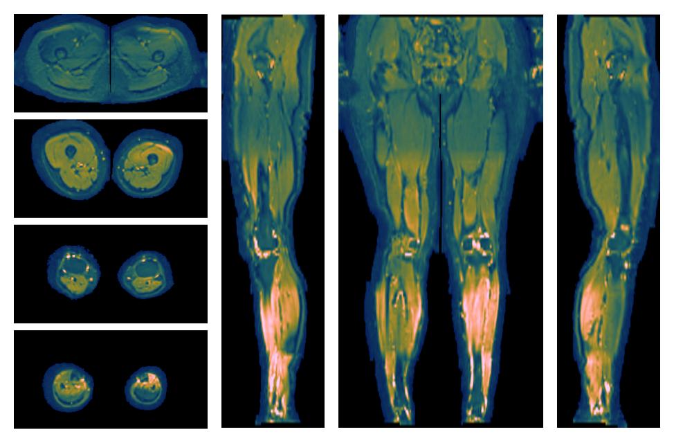 SNR distribution of the unweighted diffusion data.