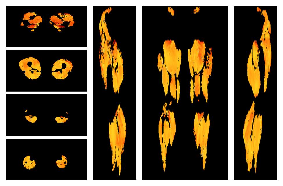 Muscle fiber tract angle map based on whole leg DTI based fiber tractography.