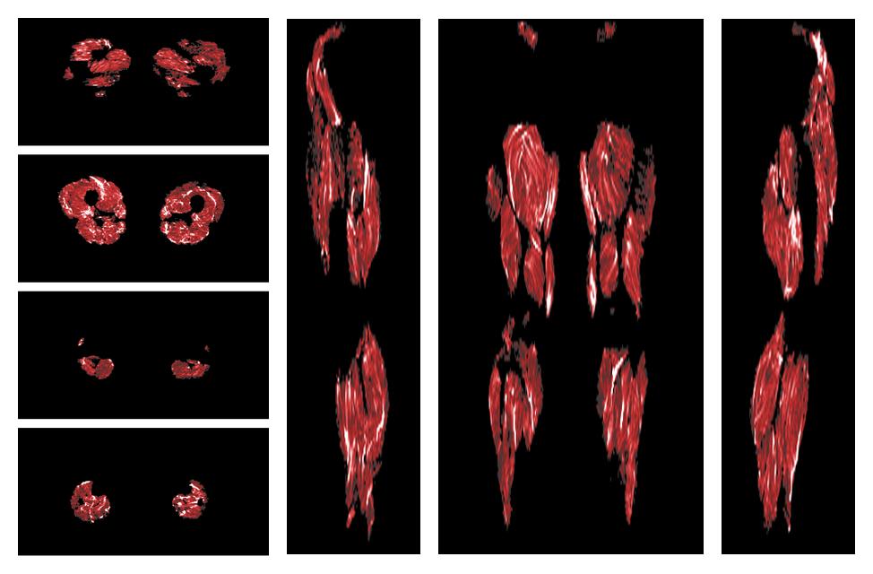 Muscle fiber tract density map based on whole leg DTI based fiber tractography.