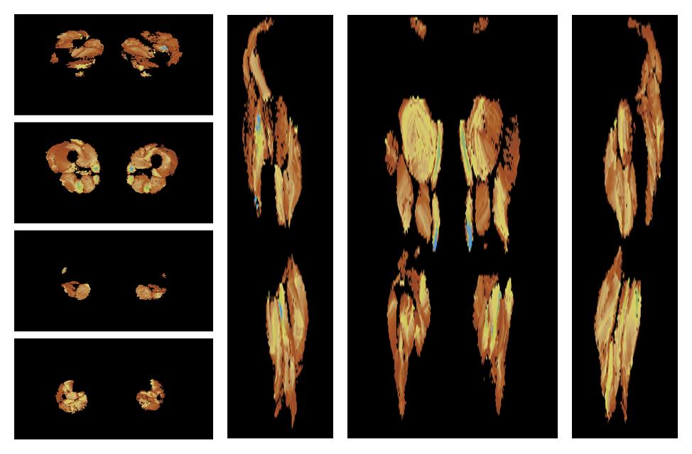 Muscle fiber tract length map based on whole leg DTI based fiber tractography.