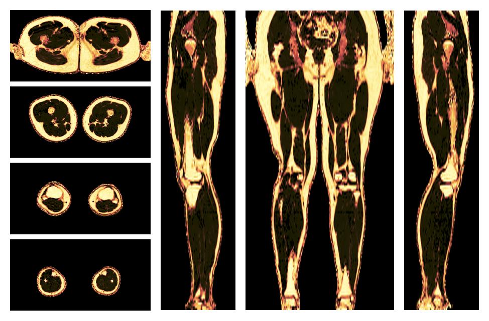 The fat fraction of the lower extremity obtained from the dixon reconstruction for muscle water fat quantification.