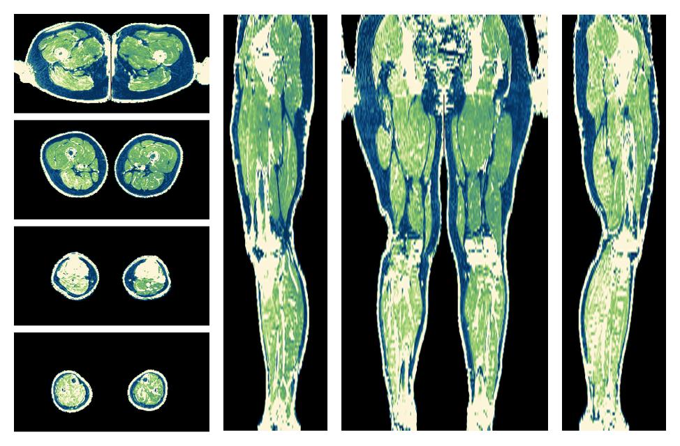 The R2 star relaxation time of the lower extremity obtained from the dixon reconstruction for muscle water fat quantification.