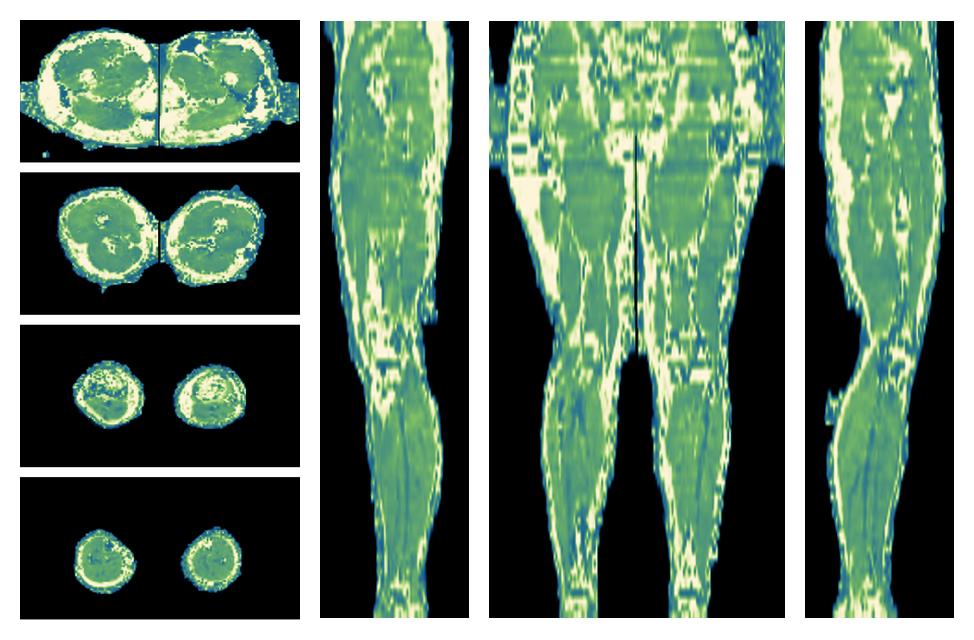 The water only T2 relaxation time of the lower extremity obtained from multi echo spin echo t2 mapping with EPG based reconstruction.