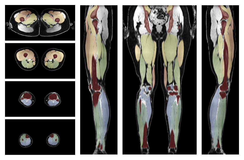 Overlay of automated muscle segmentation labels on dixon water image.