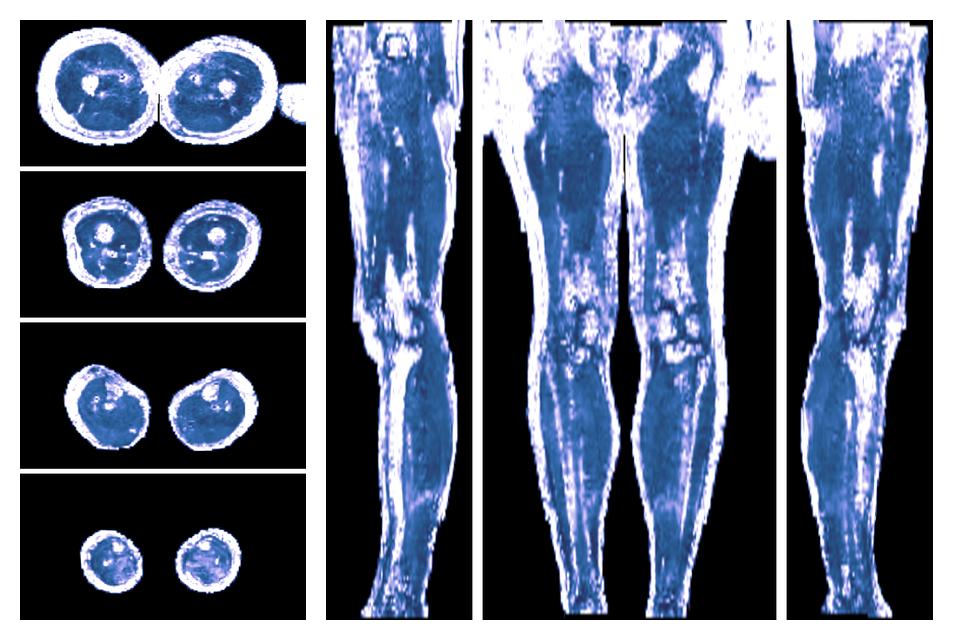 IVIM corrected whole leg muscle fractional anisotropy obtained from diffusion tensor imaging.