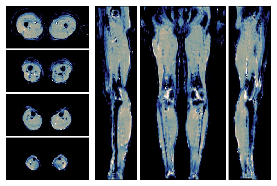 IVIM corrected whole leg muscle mean diffusivity obtained from diffusion tensor imaging.