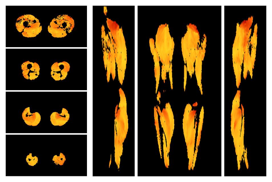 Muscle fiber tract angle map based on whole leg DTI based fiber tractography.