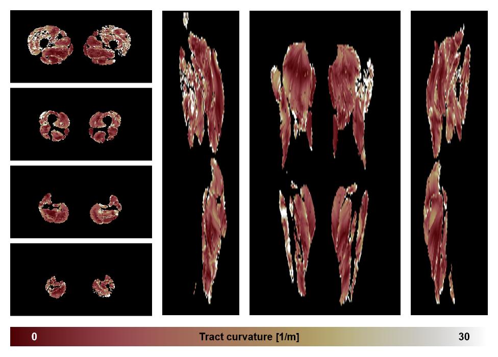 Muscle fiber tract curvature map based on whole leg DTI based fiber tractography.