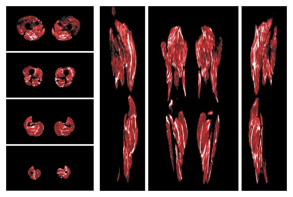 Muscle fiber tract density map based on whole leg DTI based fiber tractography.