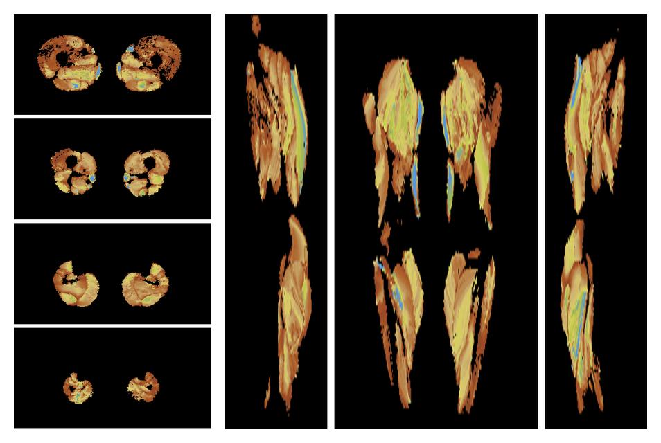 Muscle fiber tract length map based on whole leg DTI based fiber tractography.