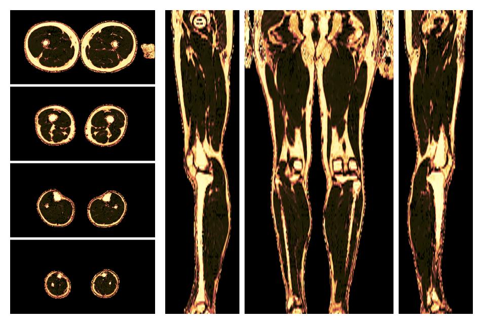 The fat fraction of the lower extremity obtained from the dixon reconstruction for muscle water fat quantification.