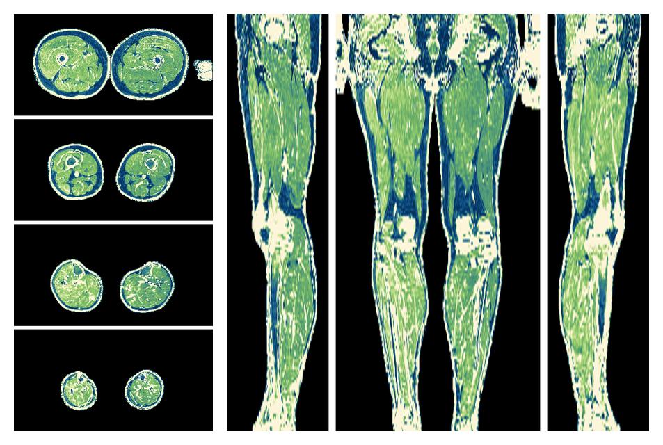 The R2 star relaxation time of the lower extremity obtained from the dixon reconstruction for muscle water fat quantification.