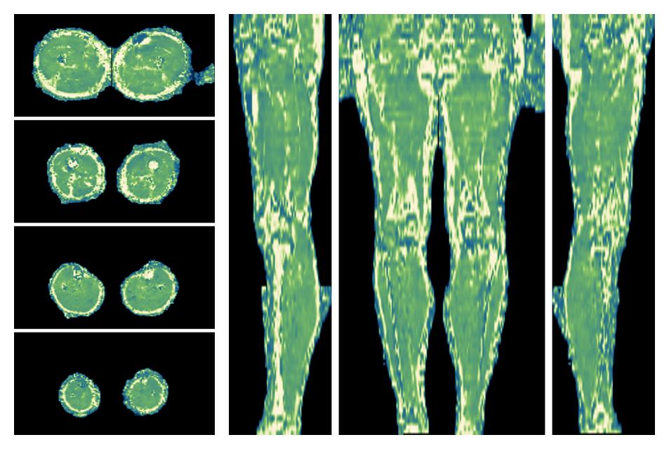 The water only T2 relaxation time of the lower extremity obtained from multi echo spin echo t2 mapping with EPG based reconstruction.