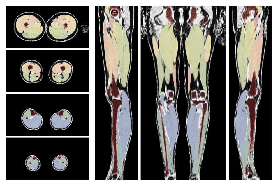 Overlay of automated muscle segmentation labels on dixon water image.