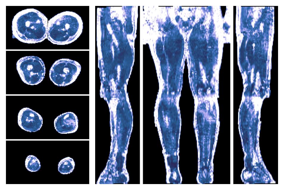 IVIM corrected whole leg muscle fractional anisotropy obtained from diffusion tensor imaging.