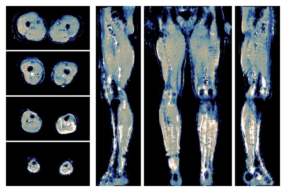 IVIM corrected whole leg muscle mean diffusivity obtained from diffusion tensor imaging.