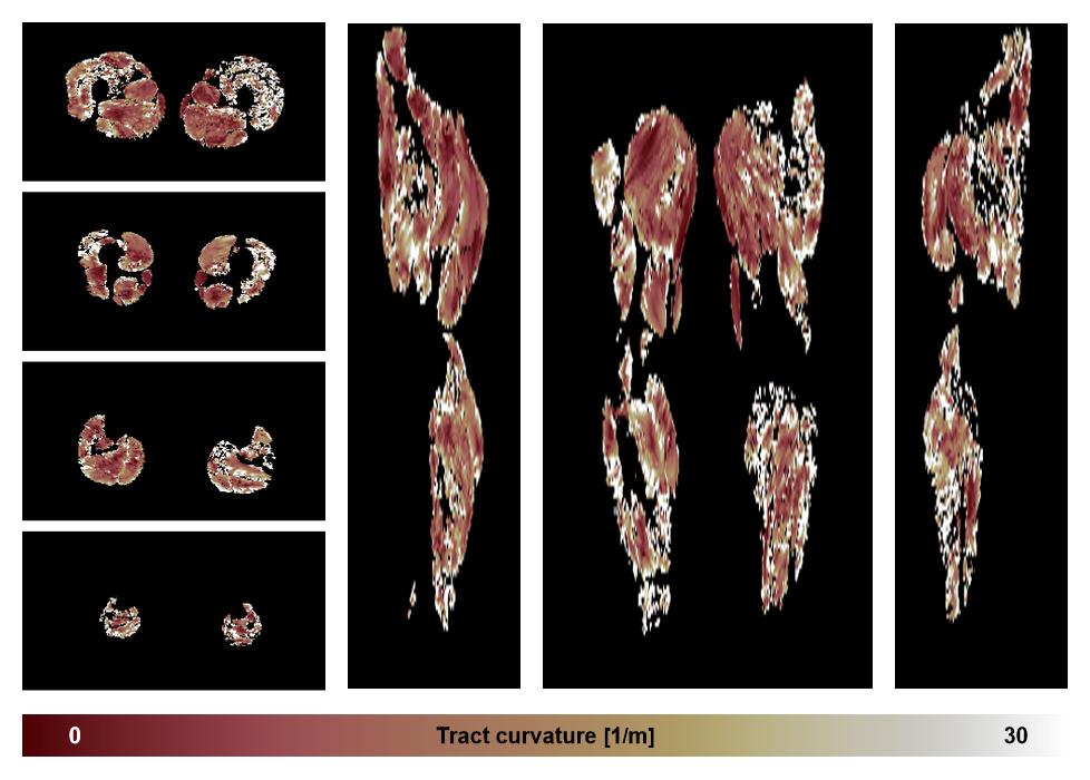 Muscle fiber tract curvature map based on whole leg DTI based fiber tractography.