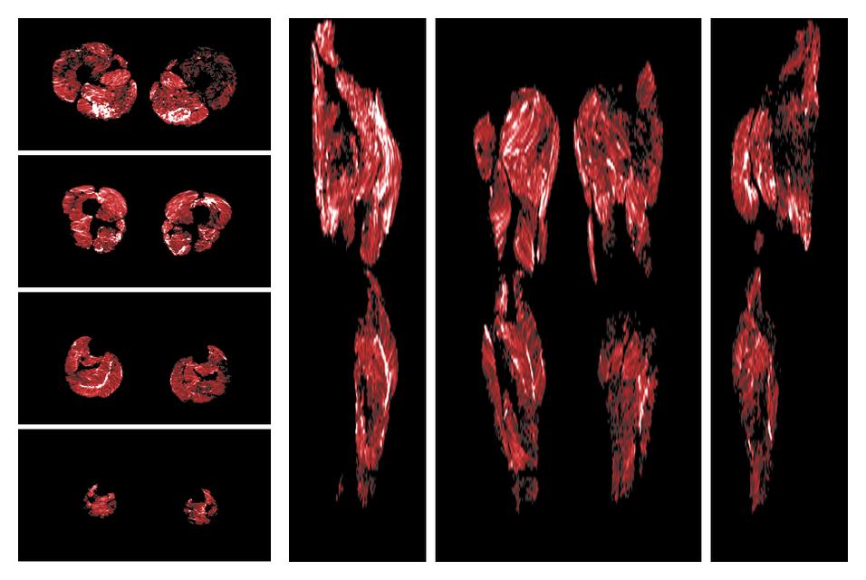 Muscle fiber tract density map based on whole leg DTI based fiber tractography.