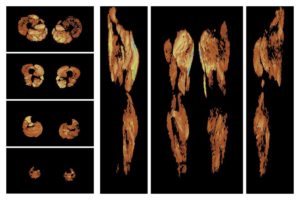 Muscle fiber tract length map based on whole leg DTI based fiber tractography.