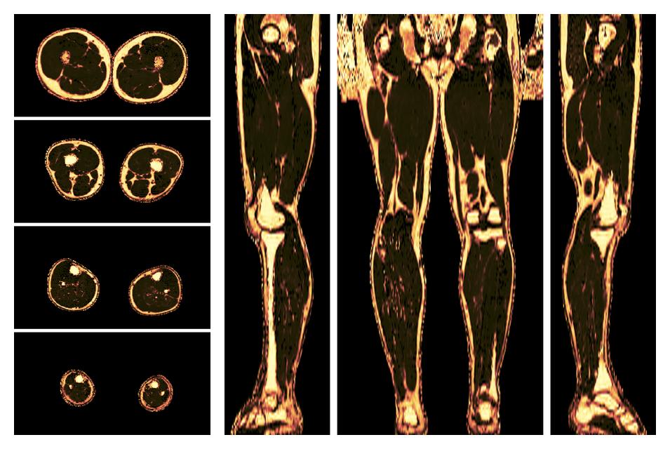 The fat fraction of the lower extremity obtained from the dixon reconstruction for muscle water fat quantification.