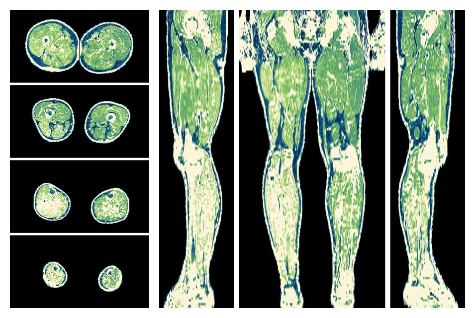 The R2 star relaxation time of the lower extremity obtained from the dixon reconstruction for muscle water fat quantification.