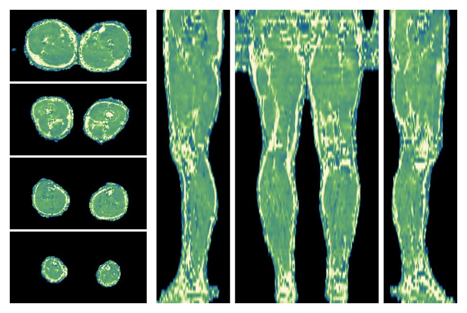 The water only T2 relaxation time of the lower extremity obtained from multi echo spin echo t2 mapping with EPG based reconstruction.