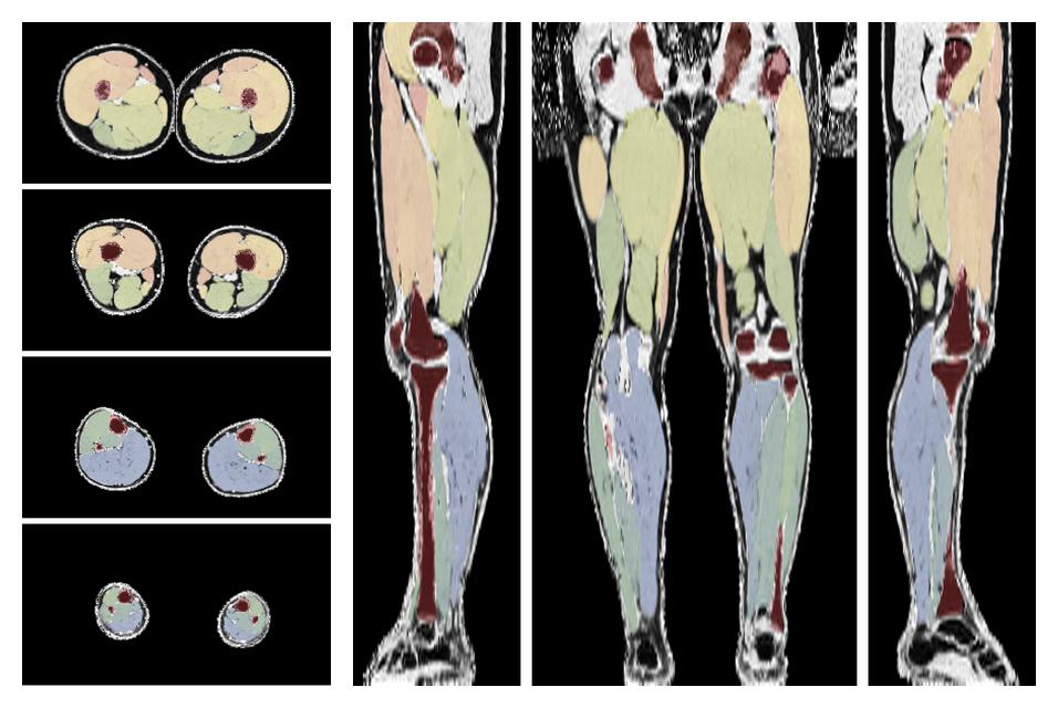 Overlay of automated muscle segmentation labels on dixon water image.