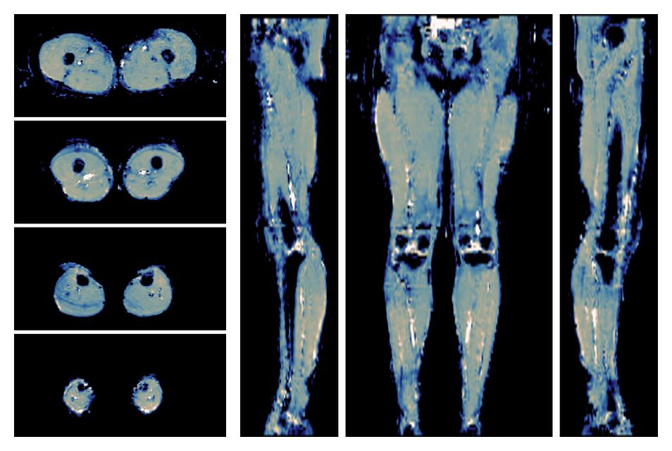 IVIM corrected whole leg muscle mean diffusivity obtained from diffusion tensor imaging.