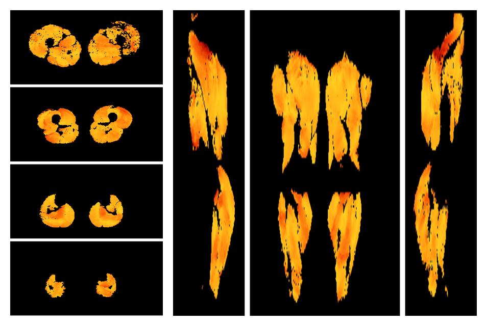 Muscle fiber tract angle map based on whole leg DTI based fiber tractography.