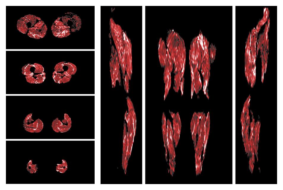 Muscle fiber tract density map based on whole leg DTI based fiber tractography.