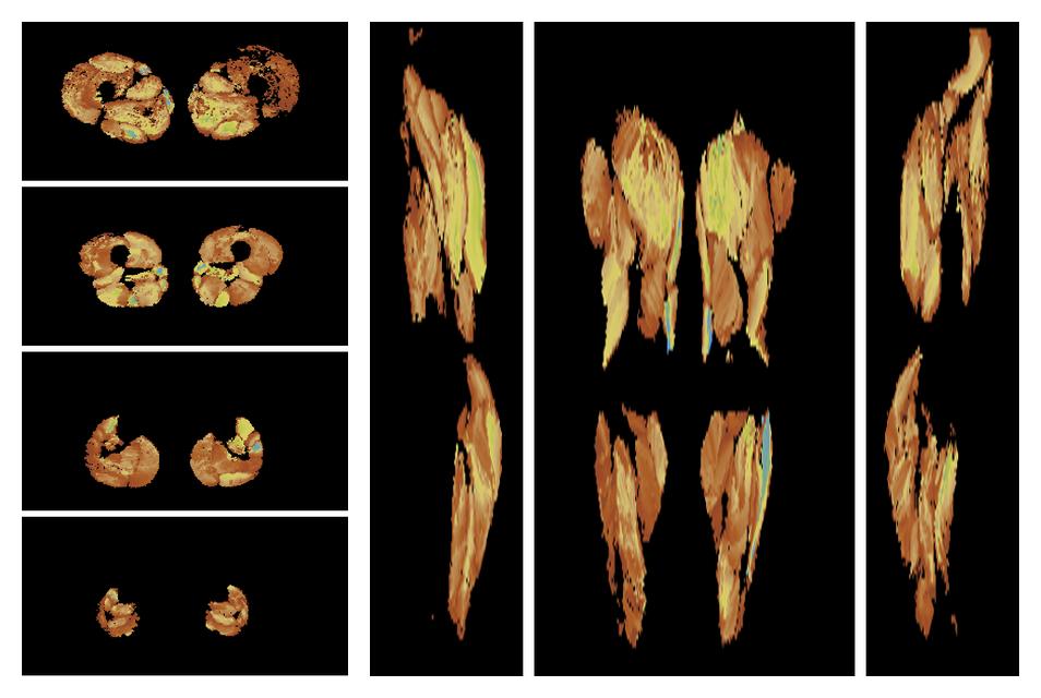 Muscle fiber tract length map based on whole leg DTI based fiber tractography.