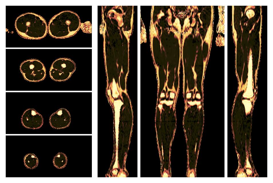 The fat fraction of the lower extremity obtained from the dixon reconstruction for muscle water fat quantification.