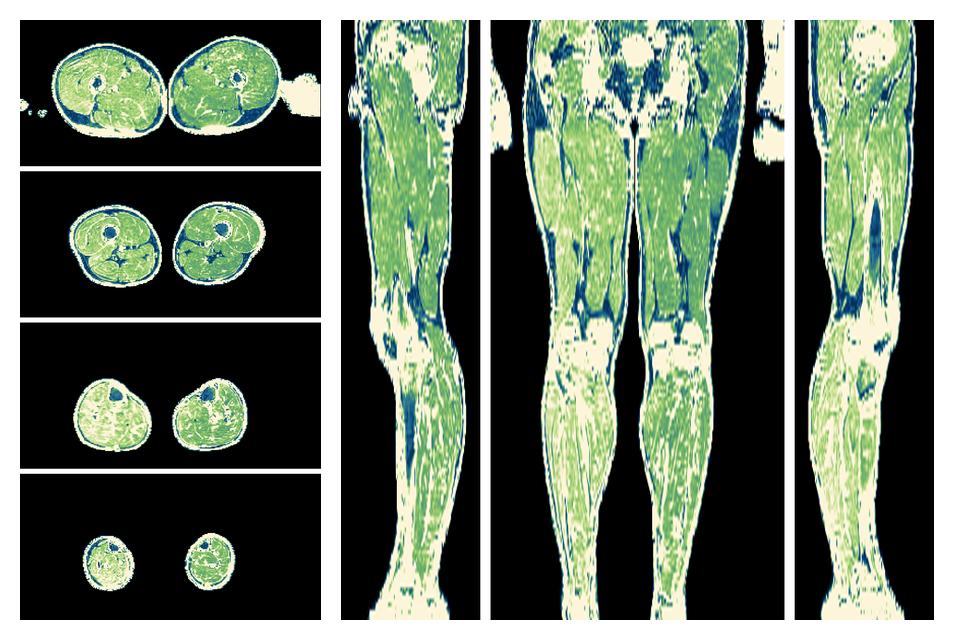 The R2 star relaxation time of the lower extremity obtained from the dixon reconstruction for muscle water fat quantification.