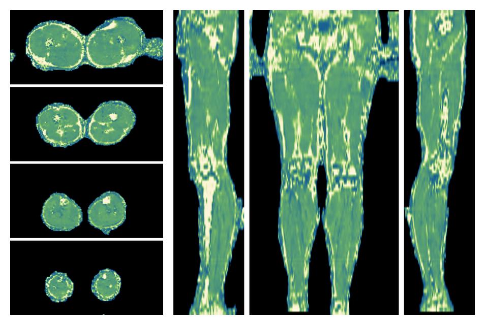 The water only T2 relaxation time of the lower extremity obtained from multi echo spin echo t2 mapping with EPG based reconstruction.