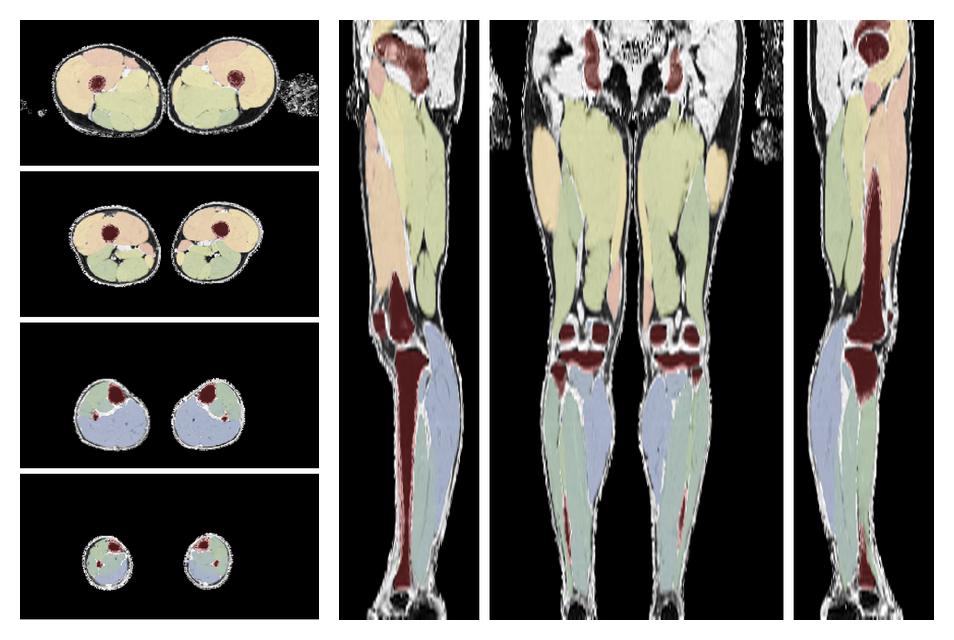 Overlay of automated muscle segmentation labels on dixon water image.