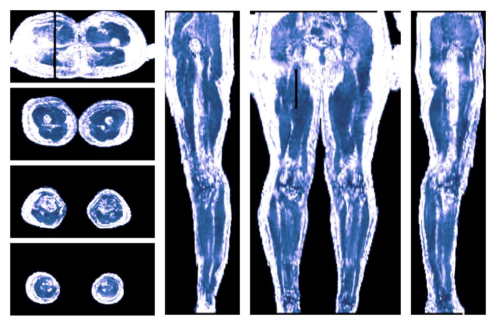 IVIM corrected whole leg muscle fractional anisotropy obtained from diffusion tensor imaging.