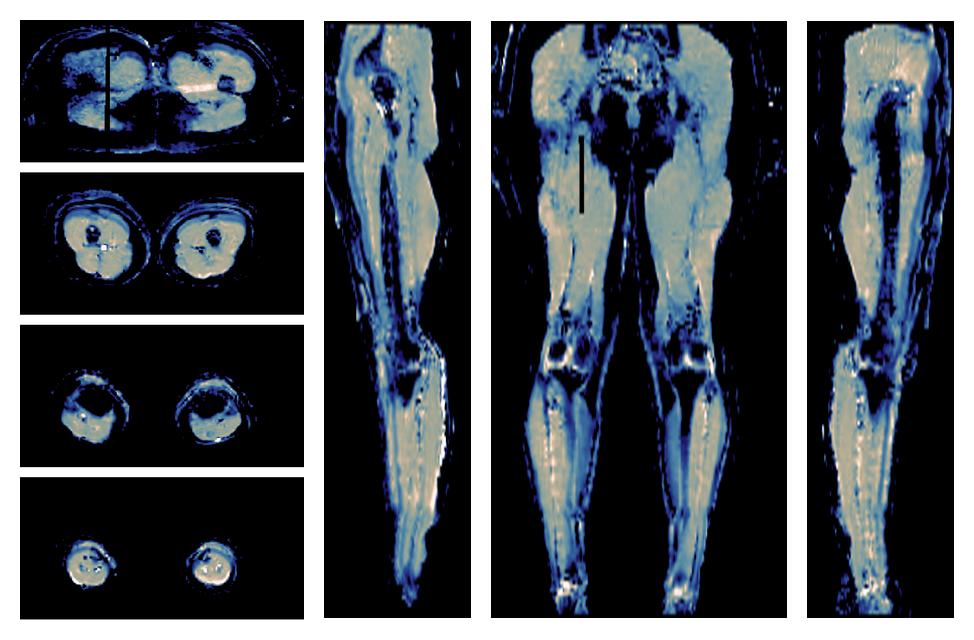 IVIM corrected whole leg muscle mean diffusivity obtained from diffusion tensor imaging.