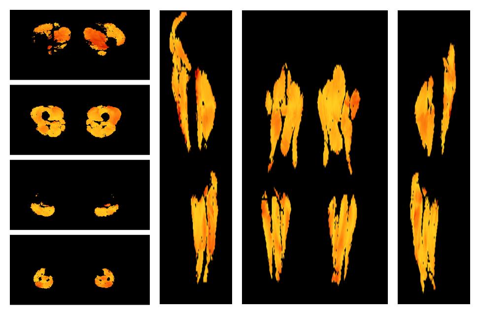 Muscle fiber tract angle map based on whole leg DTI based fiber tractography.