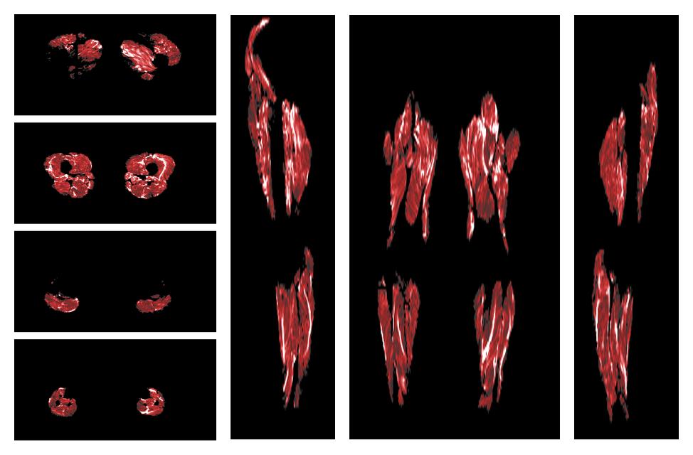 Muscle fiber tract density map based on whole leg DTI based fiber tractography.