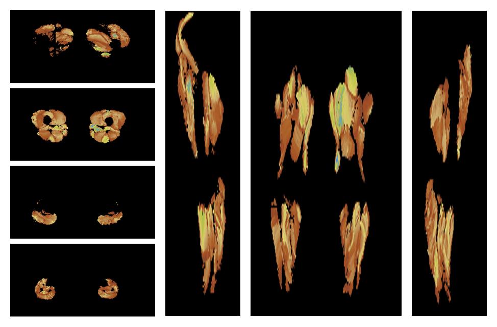 Muscle fiber tract length map based on whole leg DTI based fiber tractography.