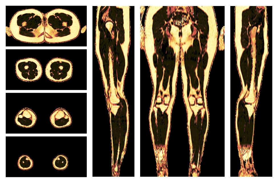 The fat fraction of the lower extremity obtained from the dixon reconstruction for muscle water fat quantification.