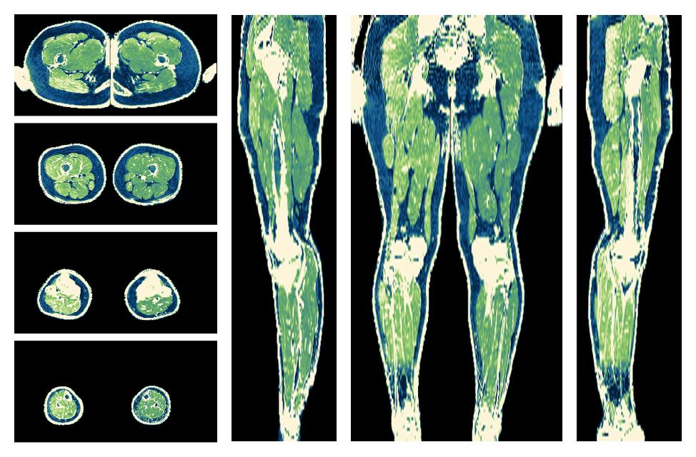 The R2 star relaxation time of the lower extremity obtained from the dixon reconstruction for muscle water fat quantification.