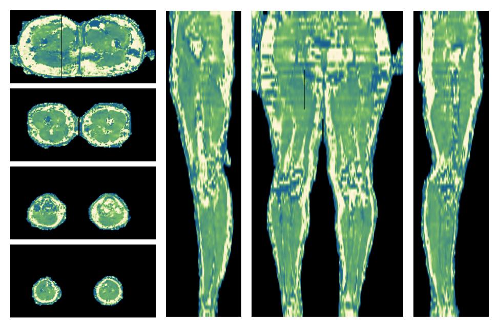 The water only T2 relaxation time of the lower extremity obtained from multi echo spin echo t2 mapping with EPG based reconstruction.